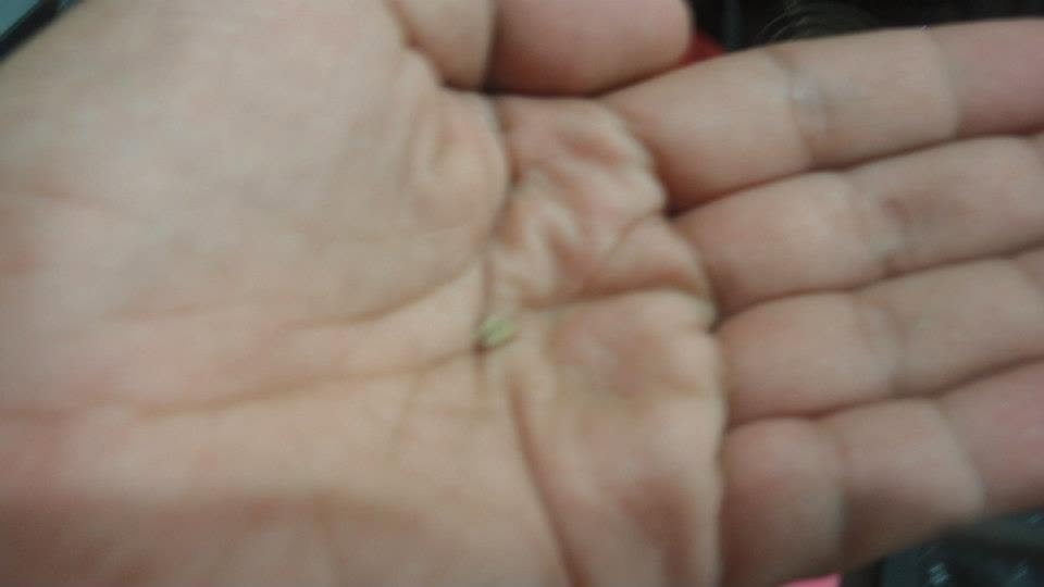 Kidney Stones